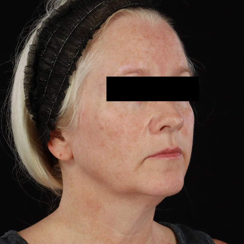 BroadBand Light™ Therapy Before & After Gallery - Patient 621119 - Image 6
