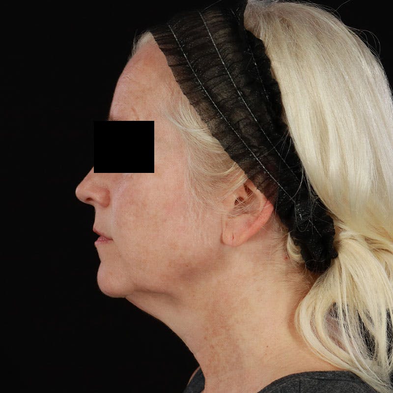BroadBand Light™ Therapy Before & After Gallery - Patient 621119 - Image 10