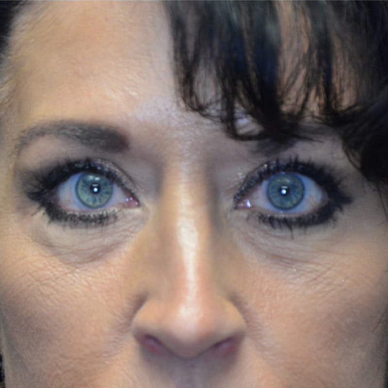 Lower Eyelid Surgery Before & After Gallery - Patient 118186865 - Image 1