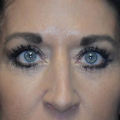 Lower Eyelid Surgery Before & After Gallery - Patient 118186865 - Image 2