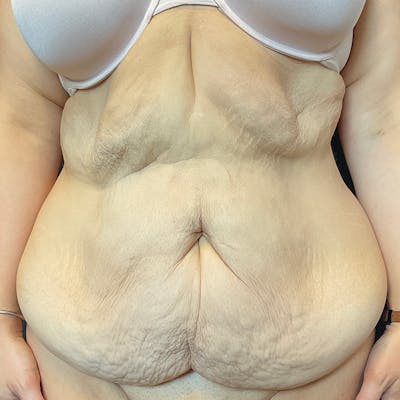 Fleur de lis Abdominoplasty Before & After Gallery - Patient 140515 - Image 1