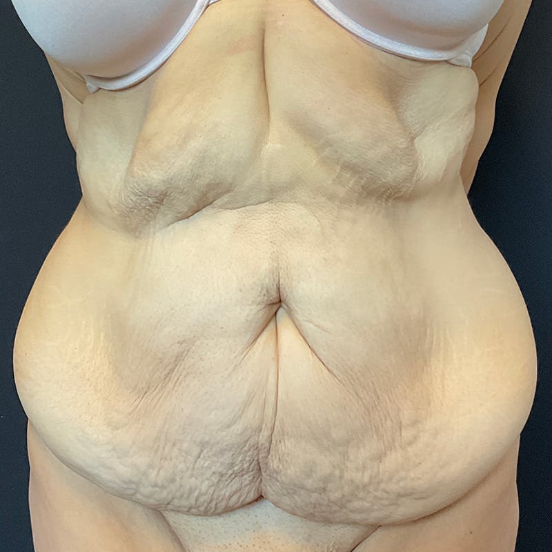 Fleur de lis Abdominoplasty Before & After Gallery - Patient 140515 - Image 3