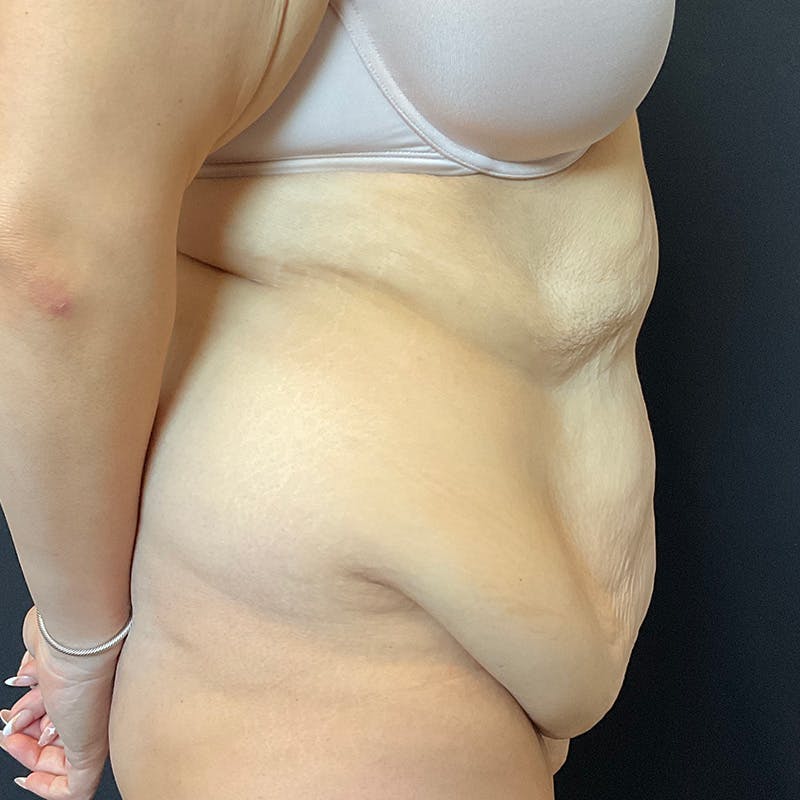 Fleur de lis Abdominoplasty Before & After Gallery - Patient 140515 - Image 7