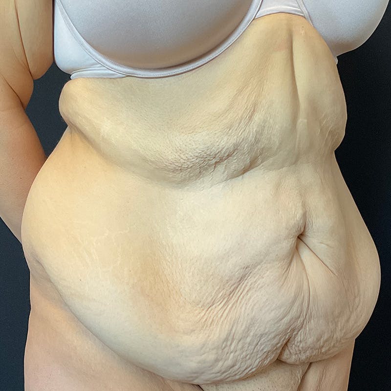 Fleur de lis Abdominoplasty Before & After Gallery - Patient 140515 - Image 5