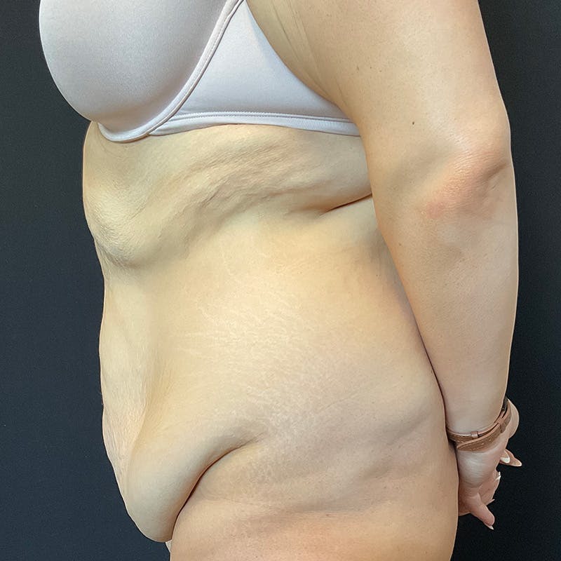 Fleur de lis Abdominoplasty Before & After Gallery - Patient 140515 - Image 11