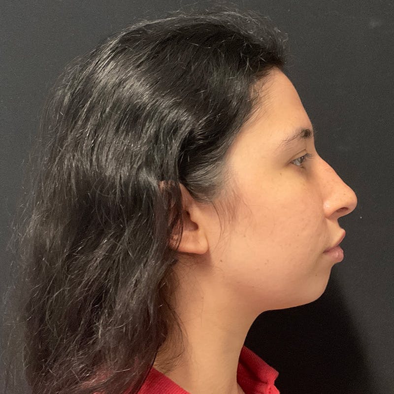 Chin Augmentation Before & After Gallery - Patient 241060 - Image 1