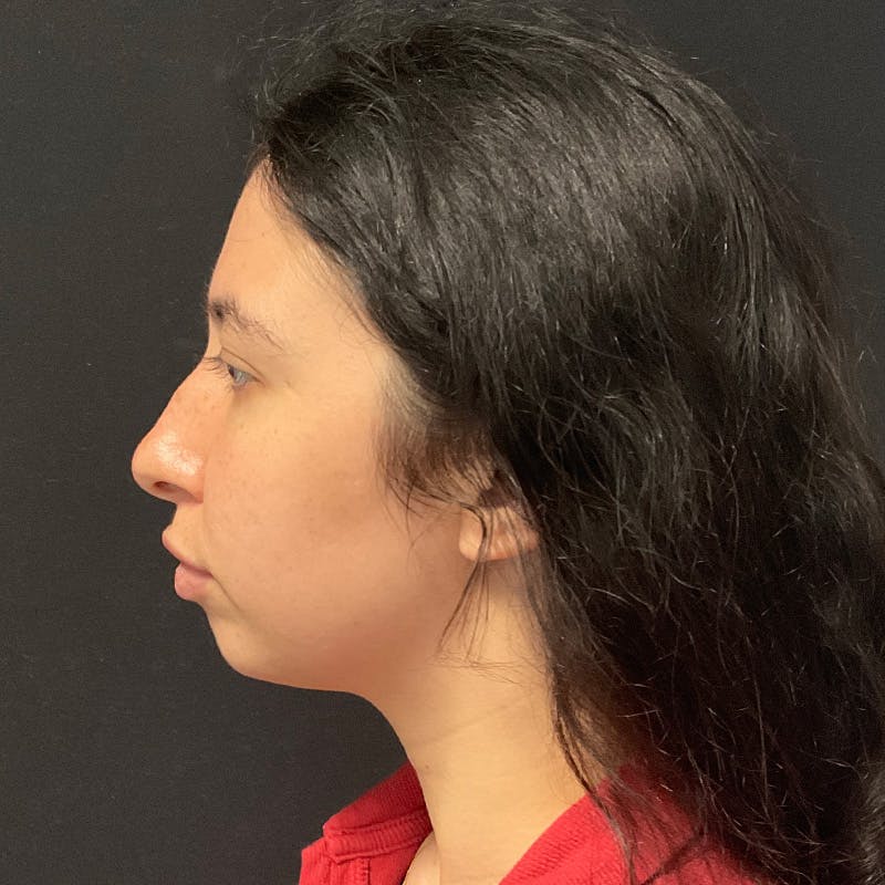 Chin Augmentation Before & After Gallery - Patient 241060 - Image 3