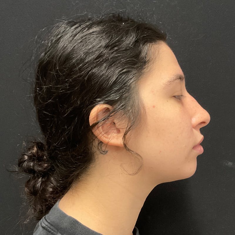 Chin Augmentation Before & After Gallery - Patient 241060 - Image 2