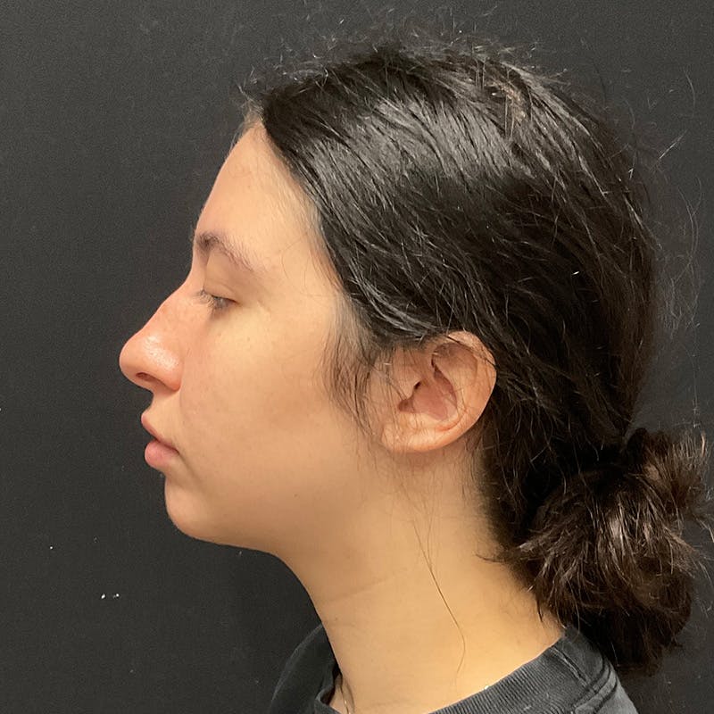 Chin Augmentation Before & After Gallery - Patient 241060 - Image 4