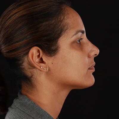 Chin Liposuction Before & After Gallery - Patient 126578 - Image 2