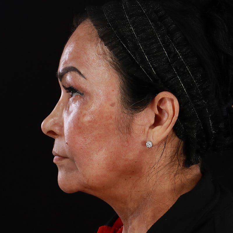 Facial Fat Grafting Before & After Gallery - Patient 418115 - Image 14