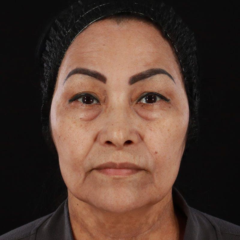 Facial Fat Grafting Before & After Gallery - Patient 418115 - Image 3