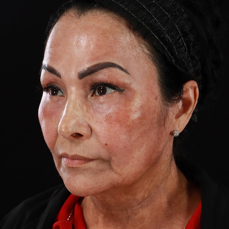 Facial Fat Grafting Before & After Gallery - Patient 418115 - Image 12