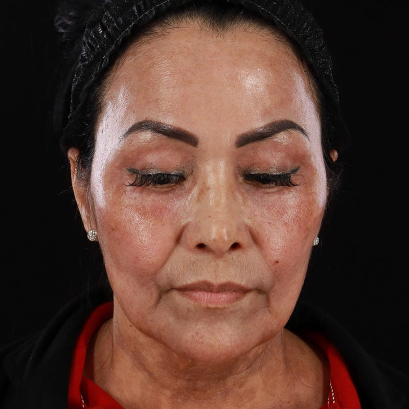 Facial Fat Grafting Before & After Gallery - Patient 418115 - Image 6