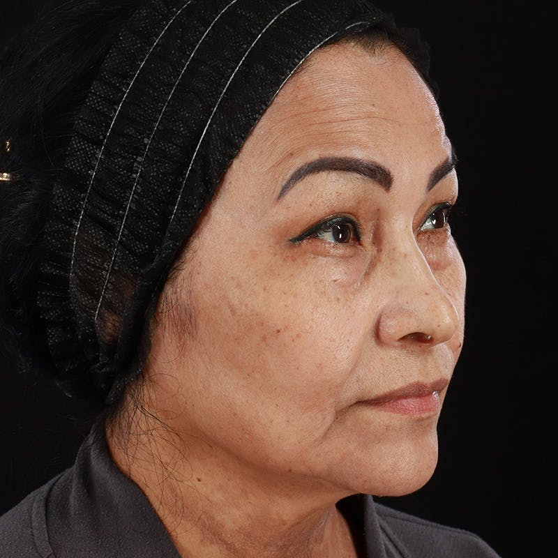 Facial Fat Grafting Before & After Gallery - Patient 418115 - Image 7