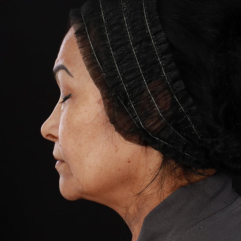 Facial Fat Grafting Before & After Gallery - Patient 418115 - Image 13