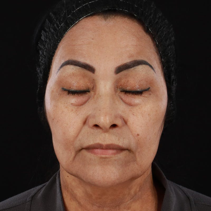 Facial Fat Grafting Before & After Gallery - Patient 418115 - Image 5