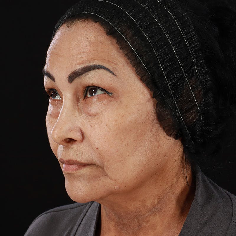 Facial Fat Grafting Before & After Gallery - Patient 418115 - Image 11