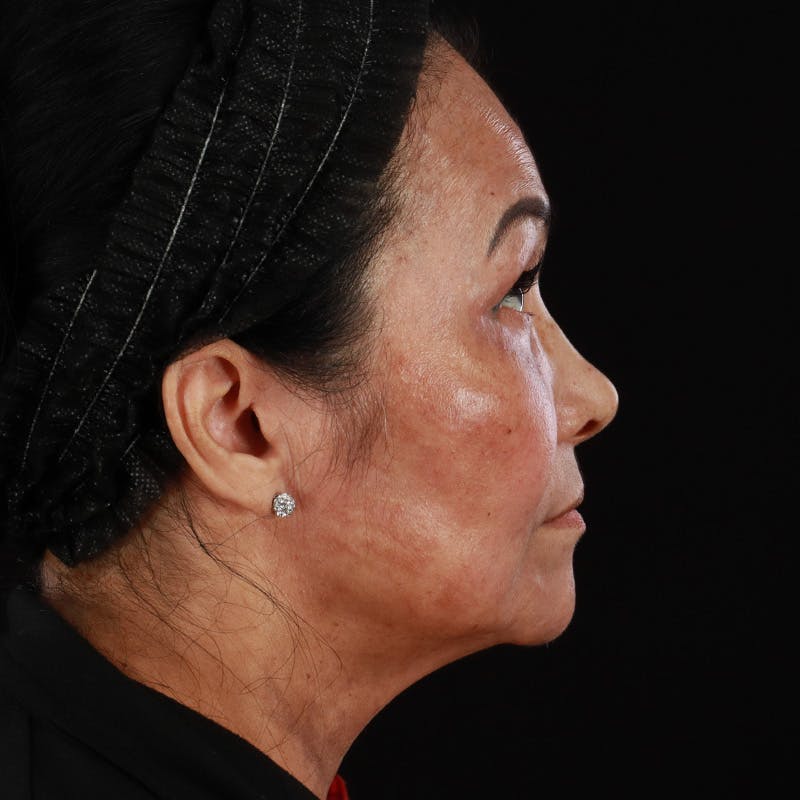 Facial Fat Grafting Before & After Gallery - Patient 418115 - Image 10