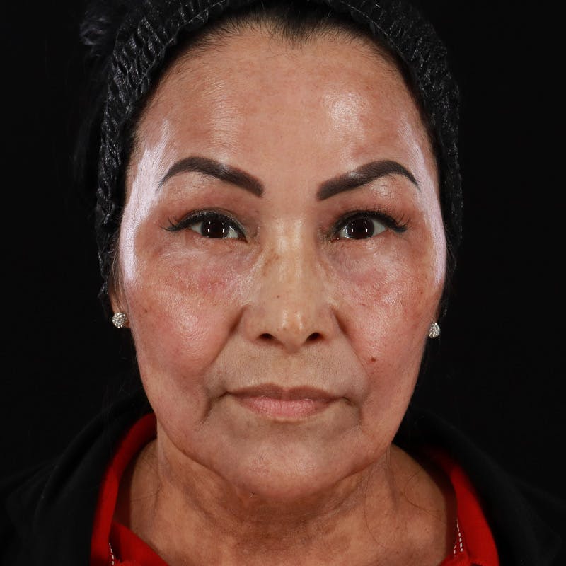 Facial Fat Grafting Before & After Gallery - Patient 418115 - Image 4