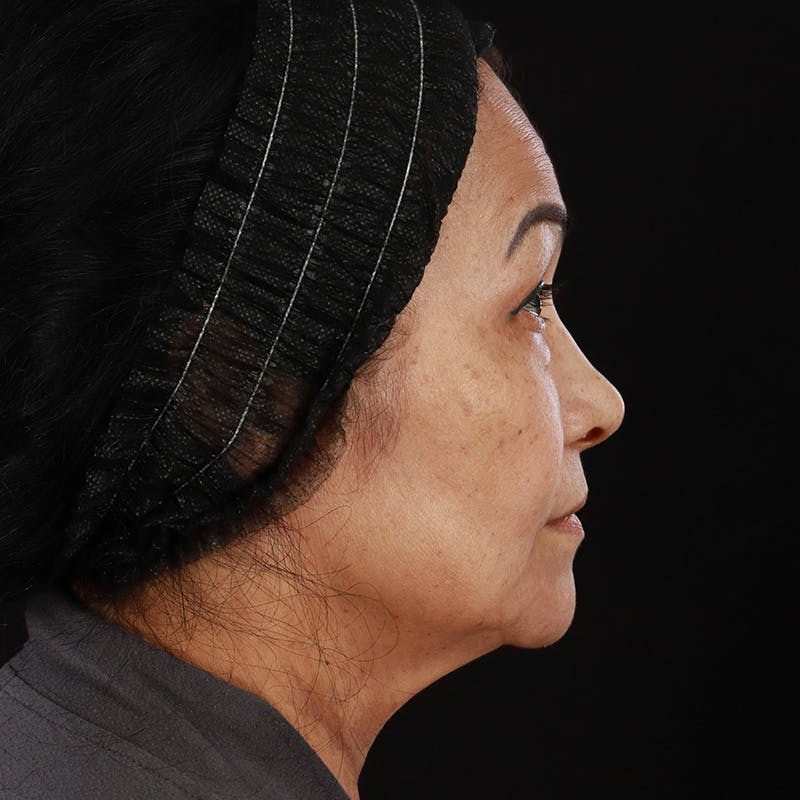 Facial Fat Grafting Before & After Gallery - Patient 418115 - Image 9