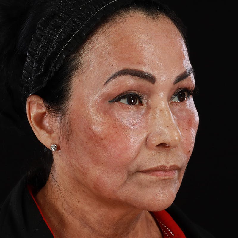 Facial Fat Grafting Before & After Gallery - Patient 418115 - Image 8