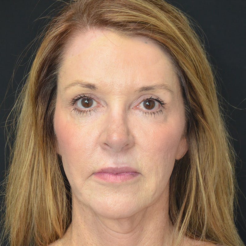 Facial Fat Grafting Before & After Gallery - Patient 296754 - Image 1