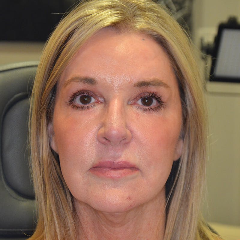 Facial Fat Grafting Before & After Gallery - Patient 296754 - Image 2