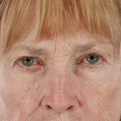 Upper Eyelid Surgery Before & After Gallery - Patient 563626 - Image 1