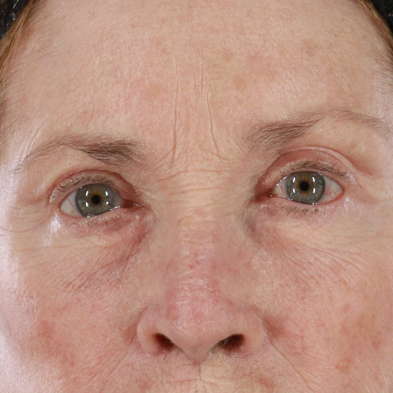 Upper Eyelid Surgery Before & After Gallery - Patient 563626 - Image 2