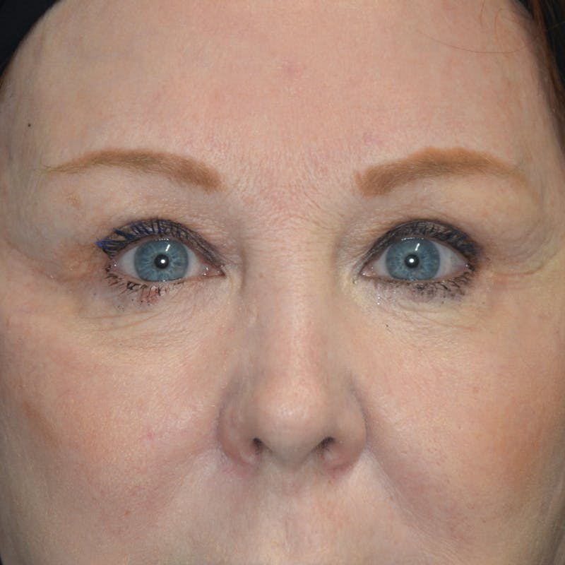 Upper Eyelid Surgery Before & After Gallery - Patient 357633 - Image 1