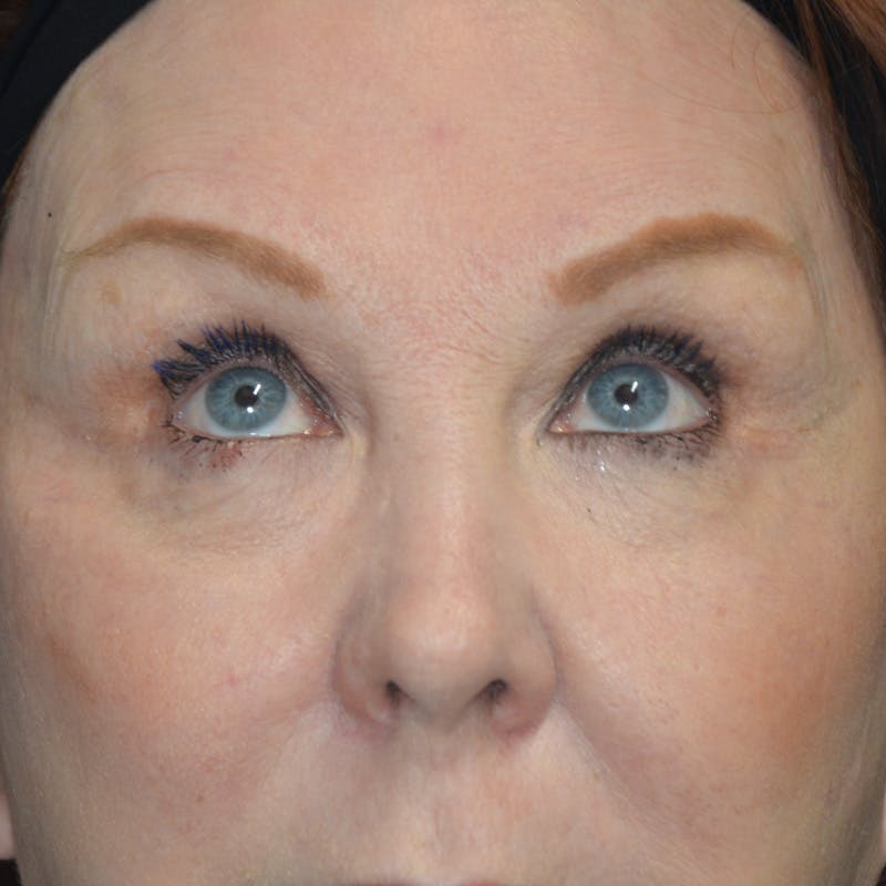 Upper Eyelid Surgery Before & After Gallery - Patient 357633 - Image 3