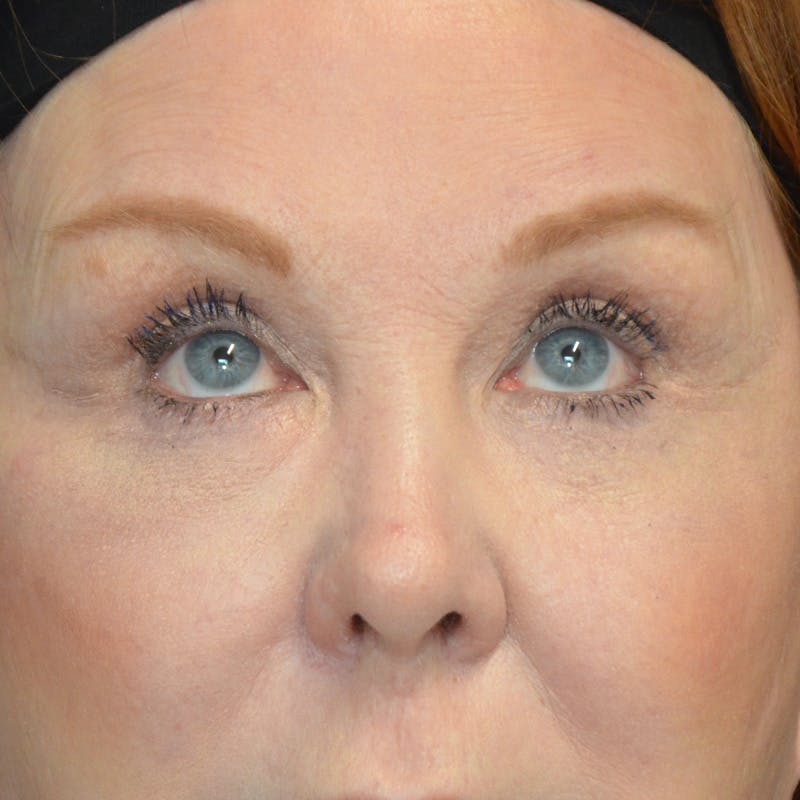 Upper Eyelid Surgery Before & After Gallery - Patient 357633 - Image 4