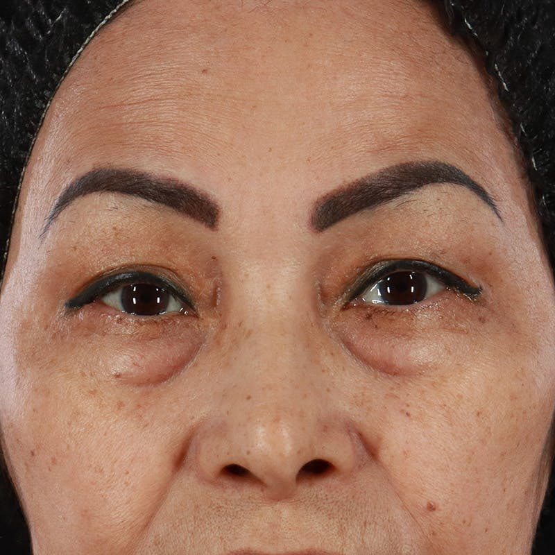 Lower Eyelid Surgery Before & After Gallery - Patient 286068 - Image 1