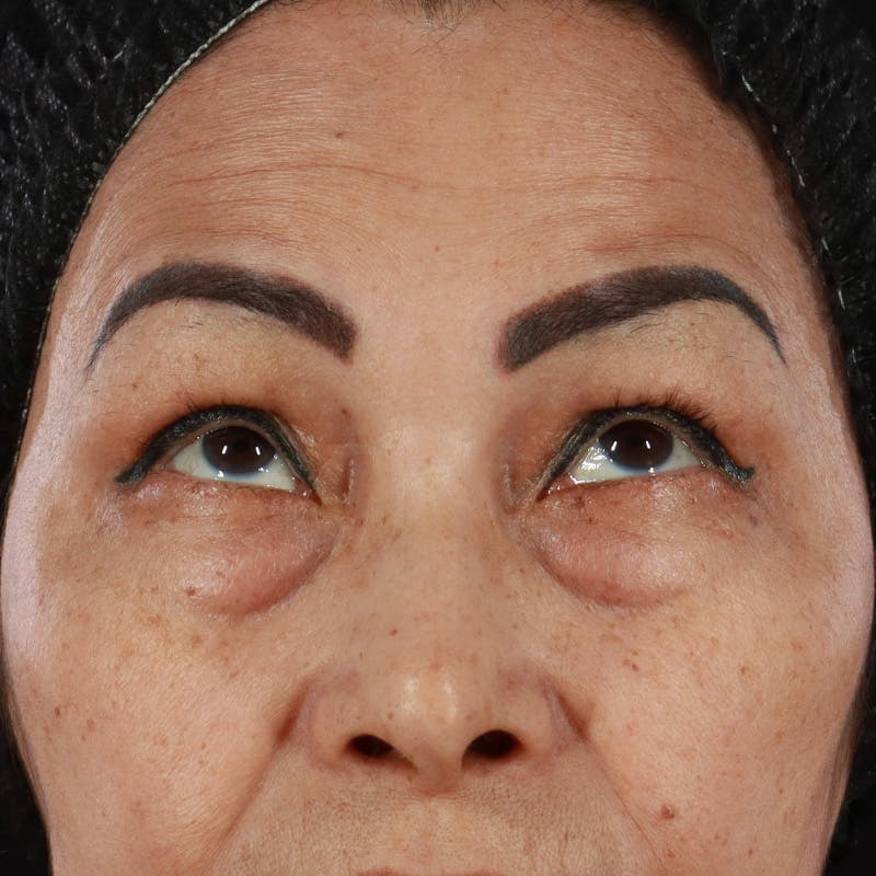 Lower Eyelid Surgery Before & After Gallery - Patient 286068 - Image 3