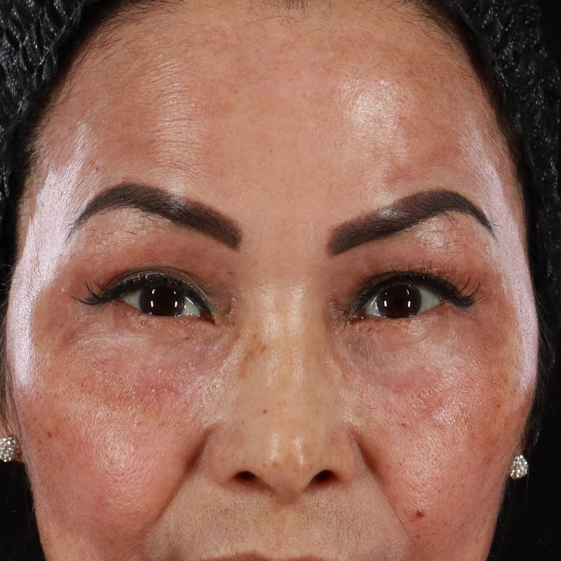 Lower Eyelid Surgery Before & After Gallery - Patient 286068 - Image 2