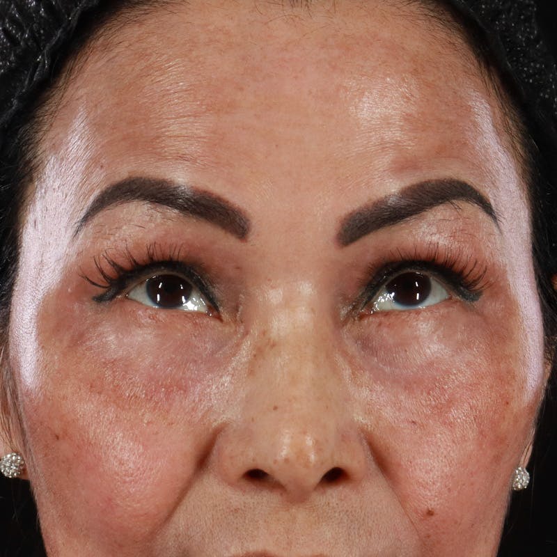Lower Eyelid Surgery Before & After Gallery - Patient 286068 - Image 4