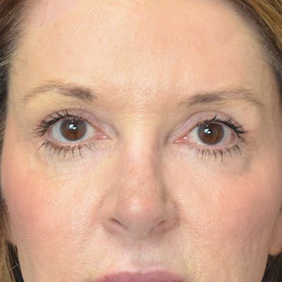 Upper Eyelid Surgery Before & After Gallery - Patient 217663 - Image 1