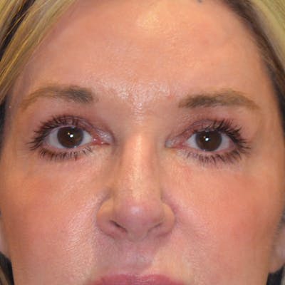 Lower Eyelid Surgery Before & After Gallery - Patient 410292 - Image 2