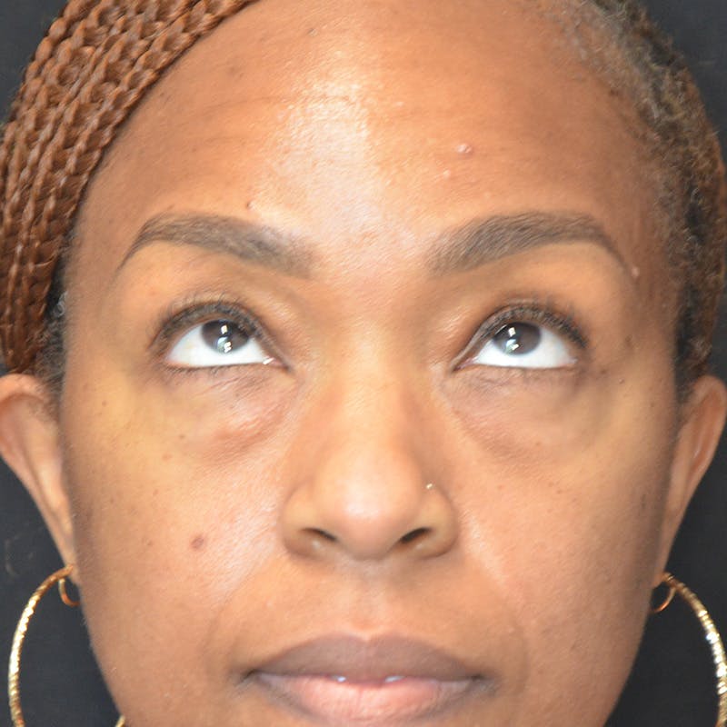 Lower Eyelid Surgery Before & After Gallery - Patient 206421 - Image 3