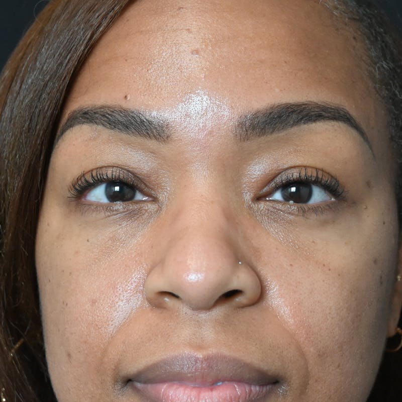 Lower Eyelid Surgery Before & After Gallery - Patient 206421 - Image 2