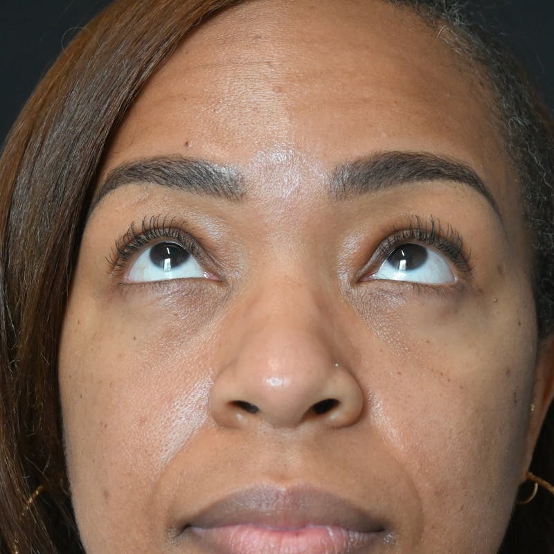 Lower Eyelid Surgery Before & After Gallery - Patient 206421 - Image 4