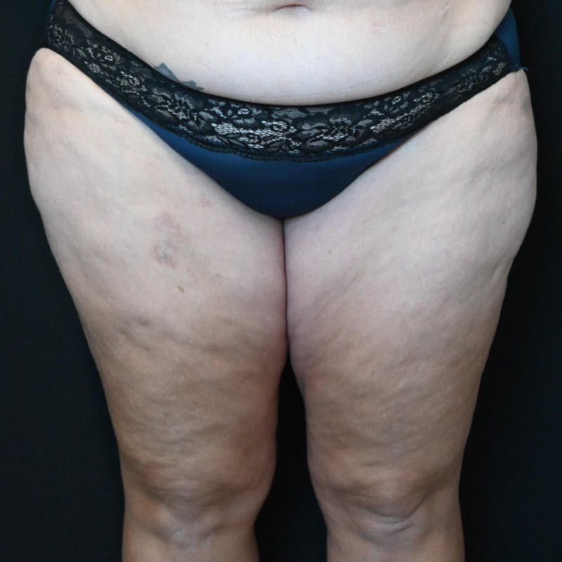 Thigh Lift Before & After Gallery - Patient 203839 - Image 1