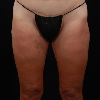 Thigh Lift Before & After Gallery - Patient 203839 - Image 2