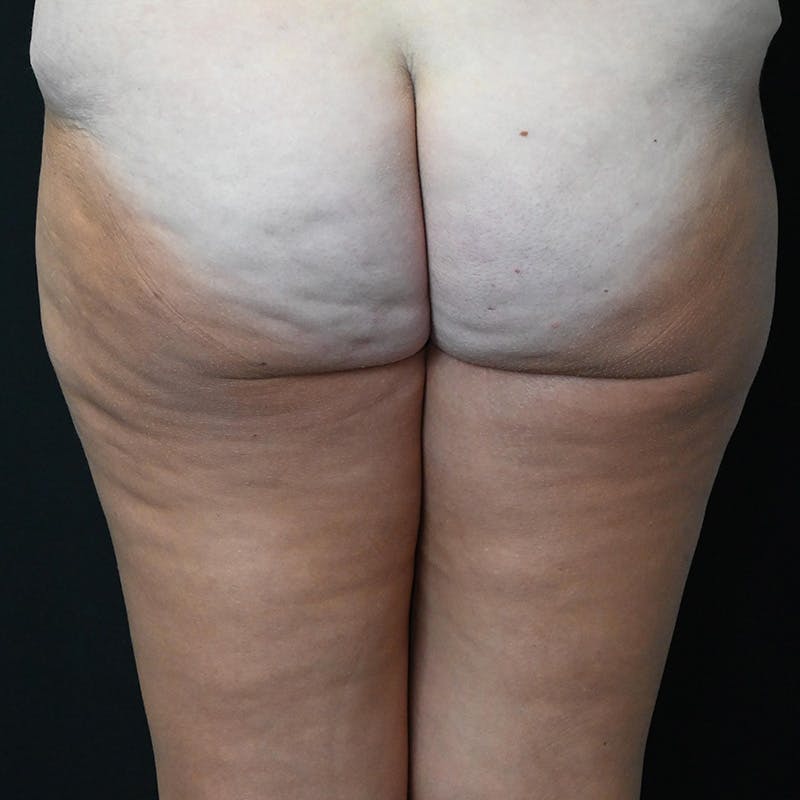Thigh Lift Before & After Gallery - Patient 428235 - Image 3