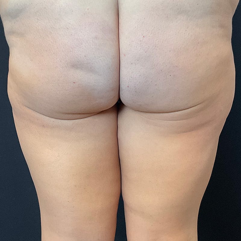 Thigh Lift Before & After Gallery - Patient 423295 - Image 3