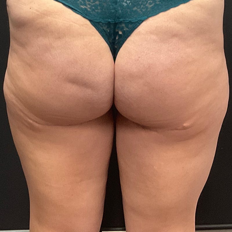 Thigh Lift Before & After Gallery - Patient 423295 - Image 4