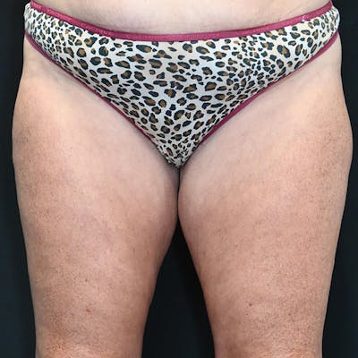 Thigh Lift Before & After Gallery - Patient 162572 - Image 1