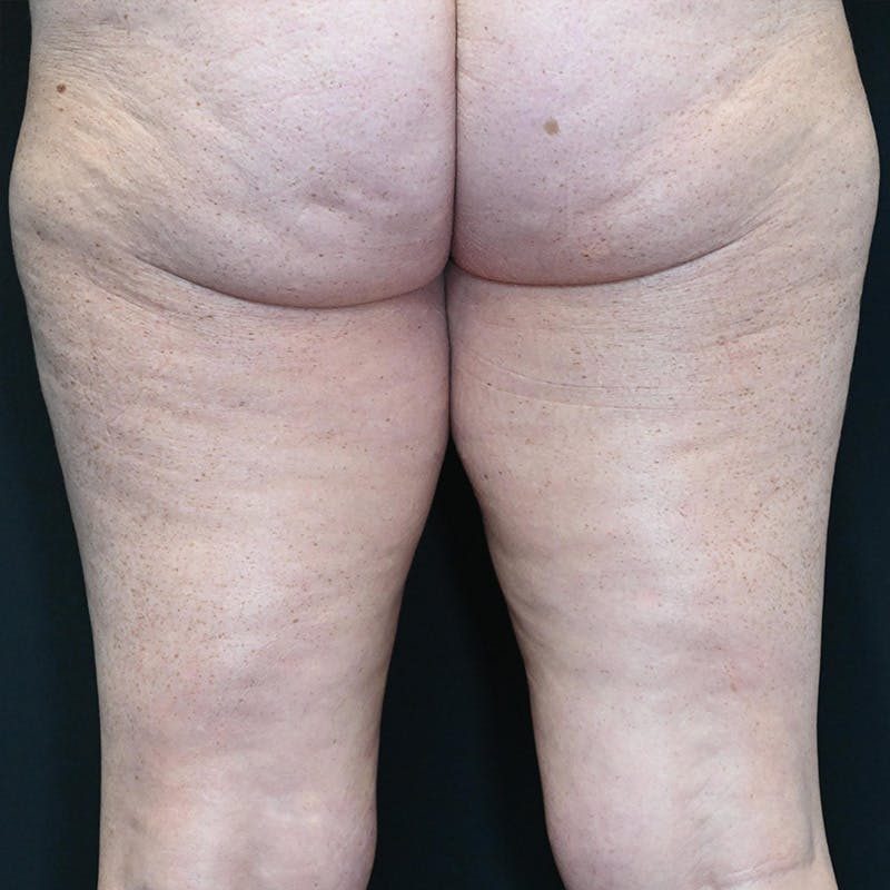 Thigh Lift Before & After Gallery - Patient 162572 - Image 3