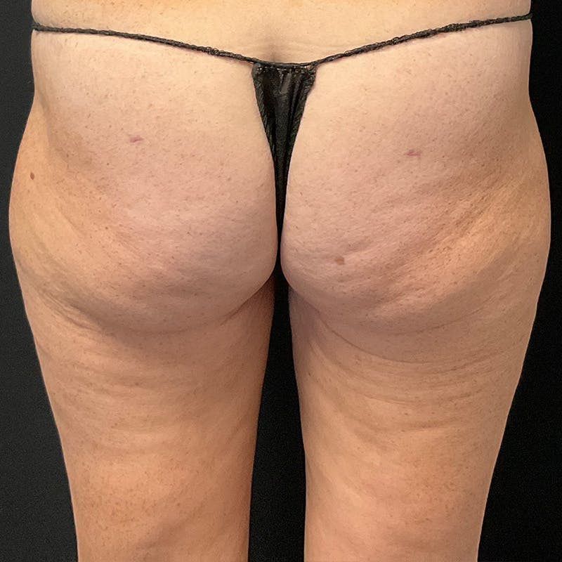 Thigh Lift Before & After Gallery - Patient 162572 - Image 4
